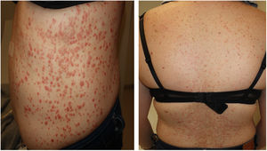 Pápulas eritematosas con leve hiperqueratosis en el tronco.