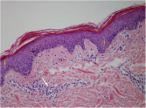 A) Flecha negra: paraqueratosis. B) Flecha naranja: espongiosis. C) Flecha blanca: exocitosis linfocítica focal sobre dermis con infiltrado linfocitario perivascular superficial.