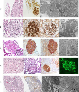 Histología de los casos clínicos. Caso 1: hematoxilina-eosina (H&E), DNAJB9, microscopía electrónica (ME). Caso 2: H&E, DNAJB9, C4d, ME. Caso 3: tinción metenamina de plata, C4d, DNAJB9, ME. Caso 4: H&E, tinción metenamina de plata, DNAJB9 e inmunofluorescencia IgG. Caso 5: H&E, DNAJB9 negativa, ME.