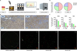 A) Flujo de trabajo de ExoView®. La orina, sin aislar previamente las VEs, se añade sobre la parte central del chip, que contiene los pocillos donde se capturan las VEs por las diferentes tetraspaninas (CD63, CD81 y CD9). Estas VEs se marcan por fluorescencia en verde en caso de expresar AMN o en rojo si expresan SFRP1. Los chips se leen y analizan en el ExoView® R200. B) Análisis de AMN y SFRP1 en tejido renal humano por inmunohistoquímica. Se aprecian tanto los glomérulos como los túbulos (aumento ×10), tiñéndose únicamente estos últimos, al ser las estructuras funcionales relacionadas con nuestras proteínas de interés. C) Visualización de la captura de las proteínas de interés (AMN, SFRP1). Se muestra una imagen de uno de los pocillos de la tetraspanina de captura CD63, en la que se aprecia la unión específica y delimitada de las VEs. A la derecha, se incluye un aumento de un pocillo por cada tetraspanina de captura (CD63, CD81 y CD9, respectivamente), siendo cada punto de color una vesícula expresando AMN (proteína de membrana, en verde) o SFRP1 (proteína intracelular, en rojo). Además, se señala mediante flechas la co-localización de ambas proteínas (amarillo) en una misma VE. D) Distribución (%) de las proteínas AMN y SFRP1 por tetraspanina de captura (CD63 en rojo, CD81 en verde y CD9 en azul). E) Cuantificación de las VEs capturadas que contienen alguna de las dos proteínas de estudio (AMN en verde y SFRP1 en rojo), para cada una de las tetraspaninas (CD63, CD81 y CD9). Se muestran valores promedio de los 3 pocillos por cada tetraspanina de captura.