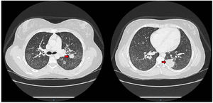 Computed tomography images of the chest. Nodular lesions (red arrow) are observed in both parenchyma with the reverse halo sign and a tree-in-bud pattern along with ground-glass opacities.