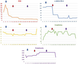 The image illustrates the analytical evolution of the patient during her hospital stay, showcasing parameters such as C-reactive protein (CRP), hemoglobin (Hb), creatinine, c-ANCA PR-3, and proteinuria over several days. The blue arrow indicates the administration of boluses of methylprednisolone at a dosage of 250mg daily for three consecutive days. The red arrow denotes an escalation of treatment involving methylprednisolone at the same dosage for five consecutive days, in addition to intravenous cyclophosphamide (500mg), intravenous rituximab (500mg), and seven sessions of plasma exchange on alternate days. Finally, the purple arrow marks the second dose of intravenous cyclophosphamide (500mg) and the second dose of intravenous rituximab (500mg). These therapeutic interventions aim to control systemic inflammation and improve the patient