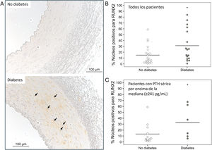 Inmunohistoquímica de RUNX2 en arterias epigástricas. A) Imágenes representativas de la expresión y localización de RUNX2 en arterias epigástricas de pacientes no diabéticos y diabéticos (las flechas indican los núcleos con tinción positiva para RUNX2). Cuantificación de núcleos positivos para RUNX2 respecto al total de núcleos en las arterias epigástricas de pacientes no diabéticos y diabéticos (*p=0,038) en B, y en pacientes no diabéticos y diabéticos con PTH sérica por encima de la media (≥241pg/mL) (*p=0,039) en C, expresados en porcentaje.