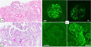 Biopsia renal. A) Se identifican 2 glomérulos con aumento de celularidad mesangial (hematoxilina-eosina, ×20). B) Se reconocen pseudotrombos focales e imágenes de doble contorno (PAS, ×20). C) Inmunofluorescencia directa, en donde se objetiva positividad frente a IgM (arriba a la izquierda) y C3 (arriba a la derecha), con predominio kappa (abajo a la derecha) frente a lambda (abajo a la izquierda).