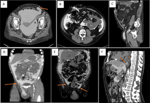 A: Bultoma abdominal debido a hernia (flecha). B: Fuga de dializado por el trayecto subcutáneo. C: Fuga de dializado por persistencia de conducto processus vaginalis. D: Fuga de dializado por disección de planos a partir de pequeño punto de fuga (flecha). E: Edema genital por hernias bilaterales (flechas).F: Fallo de ultrafiltrafiltración por fuga peritoneo pleural (flecha=punto de fuga) (estrella=derrame pleural).
