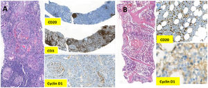 (A). Kidney biopsy; cellular crescents in the glomeruli and severe interstitial lymphoid infiltration are seen. Lymphoid infiltration is composed of the mixture of reactive CD3+ T cells and CD20+ B cells that are Cyclin D1 negative. (B). Bone marrow biopsy without involvement.