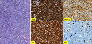 Lymph node Typical CD5 and Cyclin D1 expressing mantle cell lymphoma with very low proliferation.
