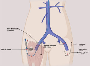 Túnel en «U» para catéter femoral tunelizado: trayecto subcutáneo, puntos natómicos clave y medidas sugeridas.