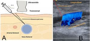 Vista ecográfica de la vena femoral común para planificación de acceso vascular femoral. A) Representación esquemática en corte transversal que muestra la medición de la distancia piel-vena femoral y la orientación de la aguja en ángulo de 30–45̊ respecto a la piel, evitando la arteria femoral. B) Imagen ecográfica longitudinal con Doppler color de la vena femoral común, en la que se señala la distancia piel-vena útil para planear la creación de un túnel subcutáneo en «U» guiado por ultrasonido.