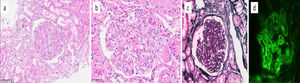 Histopathologic and immunofluorescence findings in C3 glomerulopathy. (a, b) Glomeruli show increased lobulation, endocapillary hypercellularity, and mesangial matrix expansion (a. H&E, ×200; b. H&E, ×400). (c) Double-contour formation is noted along the glomerular capillary walls (arrows) (Jones, ×400). (d) Immunofluorescence reveals diffuse, global, and strong (3+) deposition of C3 in glomerular capillary walls and mesangium (C3, ×400).