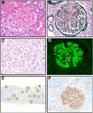 A-F) Imágenes de biopsias renales: A) Expansión mesangial importante por depósito de material eosinofílico, hematoxilina y eosina (H&E); B) Tinción de plata, evidencia áreas mesangiales expandidas por depósito no argirofílico; C) Engrosamiento marcado de las membranas basales por depósito de material eosinofílico, H&E; D) Inmunofluorescencia, tinción mesangial y en asas capilares por IgG; E) Tinción inmunohistoquímica de DNAJB9, predominante en las asas capilares; F) DNAJB9, mesangial y en asas capilares.