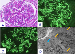 Cambios histopatológicos en la primera biopsia renal (Julio-2023). Glomérulo en el que se advierte un patrón de lesión membranoproliferativo con desdoblamientos de la MBG. Tinción de PAS x20 (A). En el estudio mediante IF directa se advierten depósitos difusos y globales cápilo-mesangiales para IgG (+++) (B) y para C3 (+++) (C), además de depósitos de cadena kappa (+++), cadena lambda (+), C1q (++), IgM (+), C4 (+) y C4d (+++). El estudio mediante ME revela la presencia de depósitos amorfos electrondensos en área mesangial y en MBG (flechas amarillas). Imágenes de desdoblamiento de la MBG (flecha azul) (D).