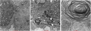 Microscopía electrónica. Se observan inclusiones lamelares tipo «cuerpos mielínicos», las asas capilares están completamente ocupadas por inclusiones lisosomales laminares concéntricas (cuerpos zebra). Los podocitos viscerales y parietales, evidencian inclusiones lisosomales laminares concéntricas en menor grado que el endotelio.
