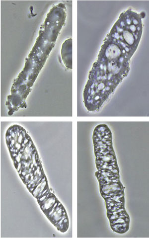 Cilindros inusuales compuestos por una matriz ligeramente granular o cérea, en cuyo interior se observan múltiples vesículas de morfología, tamaño y número variables, con aspecto similar al de inclusiones lipídicas (contraste de fases, ×400).