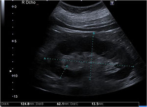 Sonda convexa de baja frecuencia (3,5-5 mHz) colocada entre línea axilar media y línea axilar anterior. Plano longitudinal de riñón derecho. A) Eje longitudinal, B) Eje transversal, C) Grosor parenquimatoso.