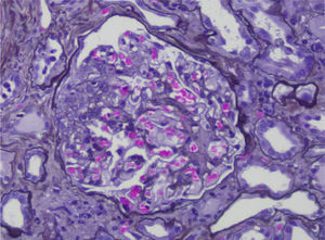 Methenamine silver stain. Segmental sclerotic lesion within a glomerulus.