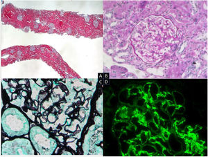 Biopsia renal. Microscopia óptica. A) Parénquima cortical renal con arquitectura general conservada sin cambios crónicos significativos (tricrómico de Masson). B) Glomérulos sin expansión mesangial, lesiones proliferativas ni otras alteraciones morfológicas (PAS, 20×). C) Glomérulo con proyecciones espiculares («spikes») de la membrana basal de forma muy focal (plata, 40×). D) IFD: depósito de IgG y C3 granular mesangial y en asas capilares e IgM y C1q mesangial (IgG, 40×).