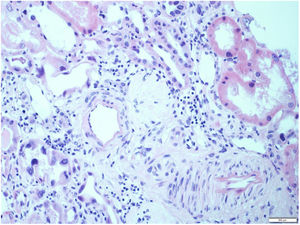Tubular cells with large, irregular and hyperchromatic nuclei, associated with acute tubular damage, lymphoplasmacytic inflammatory infiltrate, glomerular sclerosis and arteriosclerosis.