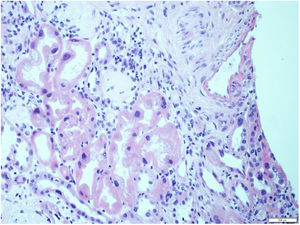 Tubular cells with large, irregular and hyperchromatic nuclei, associated with acute tubular damage.