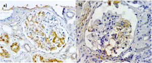 Tinción de inmunoperoxidasa con anticuerpos anti-C4d en pacientes con GEFS. a) Positivo segmentario con intensidad moderada en el mesangio y células endoteliales de los capilares glomerulares con una distribución granular uniforme. Depósitos no específicos en el citoplasma de los túbulos. b) Positivo segmentario con intensidad moderada en el mesangio y células endoteliales de los capilares glomerulares, además C4d sin expresión en el endotelio de los capilares peritubulares. Imágenes ×40.
