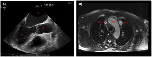 Imaging findings. (A) Transthoracic echocardiography showing a markedly dilated coronary sinus, and enlargement of left and right atrium. (B) Magnetic resonance imaging in transversal view showing a bilateral superior vena cava with a right superior vena cava and a persistent left superior vena cava. Ao, aorta; CS, coronary sinus; LA, left atrium; LSVC, left superior vena cava; RA, right atrium; RSVC, right superior vena cava.