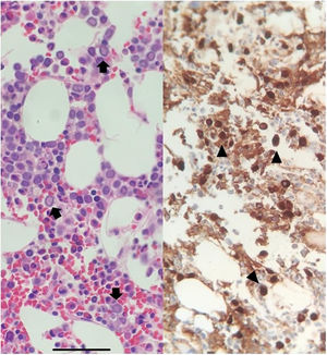 Biopsia de médula ósea del paciente. La imagen de la izquierda muestra pronormoblastos de gran tamaño y lantern cells (flechas) (tinción de hematoxilina-eosina). La imagen de la derecha muestra las inclusiones virales del parvovirusB19 (cabezas de flecha).
