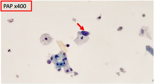 La citología de orina muestra células de aspecto atípico con núcleos hipercromáticos y citoplasma escaso (flecha roja) comparadas con las células uroteliales adyacentes normales.
