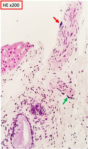 La biopsia hepática muestra, al nivel del espacio porta, células de hábito cariomegálico, algunas en disposición perineural (flecha roja) y perivascular (flecha verde) mostrando núcleos grandes, irregulares e hipercromáticos.