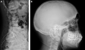 Serie ósea de paciente migrante en el que se observa el signo clásico de cráneo en sal y pimienta (B) y vértebras en jersey de rugby (A).