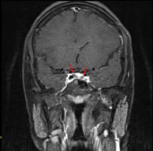 Coronal view of T1 weighted MRI sequence of the pituitary with contrast showing two differentially enhancing foci in the right and left lateral aspects (red arrows) suggestive of pituitary incidentalomas.