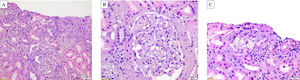 Hallazgos histopatológicos. A) La evaluación histológica se realiza en un cilindro renal con un promedio de seis glomérulos, de los cuales dos presentan esclerosis global y dos tienen fibrosis pericapsular. El intersticio presentó moderada fibrosis (40%) acompañado de atrofia tubular (20%). B) Glomérulo con incremento difuso de la matriz mesangial y engrosamiento de pared capilar, sin hipercelularidad mesangial. Arterioloesclerosis hialina. C) Cristales de contornos irregulares y translúcidos, ubicados en la luz tubular y dentro del citoplasma de las células epiteliales tubulares. El epitelio tubular mostró signos de daño tubular agudo con cambios regenerativos. En el intersticio se identificó infiltrado inflamatorio crónico. Los cristales eran marcadamente birrefringentes con la luz polarizada.