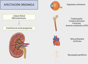 Presentación clínica y afectación sistémica de la hiperoxaluria. Creado por Biorender.com. EPO: eritropoyetina.