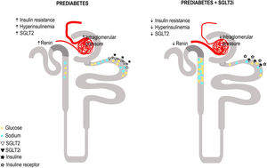 Proposed plausible mechanisms of glomerular hyperfiltration and the effect of sodium glucose cotransporter 2 inhibition (SGLT2i) in patients with prediabetes and kidney disease. Panel A: Postulated mechanisms for glomerular hyperfiltration in prediabetes and kidney disease. Prediabetes implies insulin resistance and hyperinsulinemia, sodium glucose cotransporter 2 (SGLT2) overexpression, increased glucose and sodium reabsorption, decreased intratubular sodium concentration reaching the macula densa, increased renin release and activation of the renin angiotensin aldosterone system (RAAS) cascade, resulting in an increased production of angiotensin II leading to vasoconstriction of the efferent arteriole, decrease in adenosine and this ultimately causes glomerular hyperfiltration. In panel B, the proposed effect of SGLT2i on Prediabetes and kidney disease: Decreased glucose and sodium reabsorption, decreased intrarenal glucotoxicity and the phenomenon of insulin resistance, and lower expression of the SGLT2. With the decrease in the intratubular sodium concentration that reaches the macula densa, there is less renin and Angiotensin II, this will lead to vasodilatation of the efferent arteriole and vasoconstriction of the afferent arteriole, due to the restoration of tubuloglomerular feedback, resulting in, improvement of glomerular hyperfiltration.