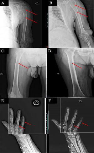 Hallazgos radiológicos con lesiones radiolúcidas en sacabocados en húmero izquierdo antes (A) y después (B), fémur derecho antes (C) y después (D) y falange media de V dedo mano derecha, antes (E) y después (F).