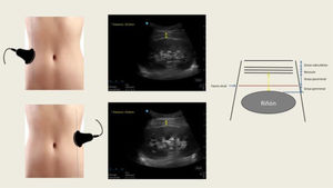 Medición ecográfica del grosor de la grasa para-perirrenal derecha e izquierda. La ecografía renal longitudinal muestra la distancia entre la musculatura de la pared abdominal y la superficie del riñón (flecha amarilla). A la derecha, se muestra el diagrama correspondiente a la ecografía. Imagen propia de los autores.