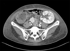 TC abdomino-pélvico (corte axial) que muestra áreas hipodensas triangulares en el injerto renal compatibles con focos de nefritis.