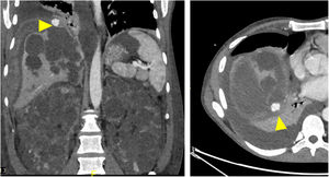 Coronal (left image) and axial (right image) CT angiography showing a large subcapsular pseudoaneurysm (yellow arrowhead) in the right lobe, posterior to the bare area of the liver. Note is made of enlarged polycystic kidneys, with significant hepatic involvement.