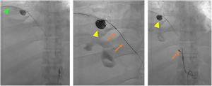 The microcatheter was advanced in the artery beyond the pseudoaneurysm sac using pushable coils (green arrowhead). Coils were deployed in the pseudoaneurysm sac (yellow arrowheads) and in the superior branch of the right phrenic artery (orange arrows).