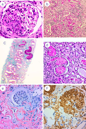 some histological diagnoses. (a) S: under light microscopy using H&E stain showing a segmental area of collapsed capillaries with increased mesangial matrix (original magnification ×200). (b) Picture suggestive of CKDu showing chronic interstitial nephritis, marked fibrosis, and sclerosed glomeruli by PAS stain (original magnification ×200). (c) Picture suggestive of CKDu showing diffuse atrophic changes with mild lymphocytic infiltrate on background of diffuse interstitial fibrosis by Masson trichrome stain (original magnification ×100). (d) Cast nephropathy by H&E, tubules showed moderate injury with large fractured PAS negative hyaline cast surrounded by tubular epithelial cells, inflammatory cells and few giant cells (original magnification ×200). (e) LECT amyloidosis glomerular and interstitial congo red uptake (original magnification ×200). (f) Anti-LECT2 antibody positive reactivity of glomeruli and interstitial deposit (immunoperoxidase technique original magnification ×200).