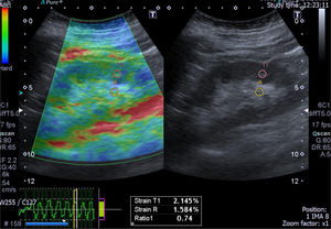 A case of acute interstitial nephritis post chemotherapy with mild interstitial fibrosis (10%). The greyscale ultrasonography image showing mild increased parenchymal echogenicity with preserved cortico-medullary differentiation, the left one showing color-coded US – elastography image showing mainly green-red scale and the sinusoidal wave of compression and decompression seen in inferior aspect of image. The circles indicate the region of interests (ROIs). The upper ROI is on the parenchyma and the lower ROI is on renal fat sinus. The radial line on the sinusoidal wave indicates the end measurement (SI=0.74).