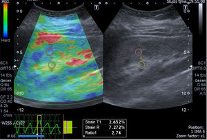 A case of light chain renal amyloidosis with moderate interstitial fibrosis (25%). The greyscale ultrasonography image showing moderate increased parenchymal echogenicity with preserved cortico-medullary differentiation, the left one showing color-coded US – elastography image showing mixed green-blue scale and the sinusoidal wave of compression and decompression seen in inferior aspect of image. The circles indicate the region of interests (ROIs). The upper ROI is on the parenchyma and the lower ROI is on renal fat sinus. The radial line on the sinusoidal wave indicates the end measurement (SI=2.74).