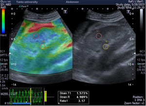 A case of focal necrotizing GN with small vessel vasculitis with marked interstitial fibrosis (55%). The greyscale ultrasonography image showing marked increased parenchymal echogenicity with relatively poor cortico-medullary differentiation, the left one showing color-coded US – elastography image showing mainly blue-green scale and the sinusoidal wave of compression and decompression seen in inferior aspect of image. The circles indicate the region of interests (ROIs). The upper ROI is on the parenchyma and the lower ROI is on renal fat sinus. The radial line on the sinusoidal wave indicates the end measurement (SI=3.17).