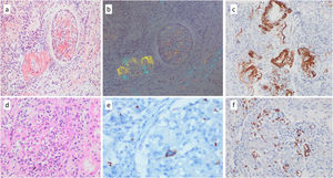 Histopathological findings in kidney biopsy. (a, b) Congo Red staining: the extracellular matrix expanding the glomerular mesangium and clearly visible in the arteriolar walls is positive with Congo Red (a), and exhibits an apple-green birefringence under polarized light (b). (c) Amyloid A: Congo Red staining highlights amyloid deposits in arterioles, arteries, and glomeruli. Strong diffuse positivity is observed with Amyloid A. (d) Glomerular Pathology: besides amyloid deposition, inflammatory cells with atypical morphology (arrow) are occasionally observed in the glomerular capillary lumens. (e) CD61 staining: megakaryocytes show positivity with CD61. (f) Glycophorin A staining: elements of the erythroid series, positive with Glycophorin A, indicate extramedullary hematopoiesis.