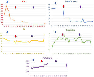 The image illustrates the analytical evolution of the patient during her hospital stay, showcasing parameters such as C-reactive protein (CRP), hemoglobin (Hb), creatinine, c-ANCA PR-3, and proteinuria over several days. The blue arrow indicates the administration of boluses of methylprednisolone at a dosage of 250mg daily for three consecutive days. The red arrow denotes an escalation of treatment involving methylprednisolone at the same dosage for five consecutive days, in addition to intravenous cyclophosphamide (500mg), intravenous rituximab (500mg), and seven sessions of plasma exchange on alternate days. Finally, the purple arrow marks the second dose of intravenous cyclophosphamide (500mg) and the second dose of intravenous rituximab (500mg). These therapeutic interventions aim to control systemic inflammation and improve the patient