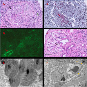 (A) H&E staining. Glomerulus with epithelial crescent formation (black arrow) showing rupture of Bowman