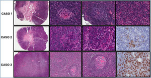 Descripción anatomopatológica de ganglios linfáticos. Caso 1: A) Panorámica de parte del ganglio linfático con medular central y cortical de patrón folicular con sinusoides dilatados. B) A mayor aumento, folículos linfoides hipoplásicos-atróficos, en los centros germinales vasos de pared hialinizada y rodeados por células linfoides del manto concéntricas («disposición en capas de cebolla»). C) En zonas interfoliculares se observa proliferación de células plasmocitoides de aspecto maduro. D) No hay imágenes de técnica IHQ, pero el resultado fue negatividad para HHV8 y EBV-EBER, así como expresión politípica de cadenas ligeras. Expresión positiva de CD30 limitada a blastos foliculares. Caso 2: A) Panorámica. Biopsia escisional de ganglio linfático con medular central y corteza ganglionar con borramiento de la arquitectura habitual del ganglio. B) Presencia de agrupaciones de blastos (recuadro). C) Marcada linfoplasmocitosis (plasmáticas marcadas con círculos). D) La IHQ muestra positividad en los blastos para HHV-8. Caso 3: A) Panorámica. Biopsia escisional de ganglio linfático con patrón folicular. B y C) A mayor aumento, folículos linfoides hipoplásico-atróficos, en los centros germinales vasos de pared hialinizada y rodeados por células linfoides del manto de forma concéntrica («disposición en capas de cebolla»). D) La IHQ muestra marcada expresión de CD23 y CD21 en centros germinales. Caso 4: Sin hay imágenes.