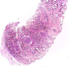 Hematoxylin–eosin stain – 4×. In the sample, 10 glomeruli were identified, 4 of them with global sclerosis (40%) and 1 with segmental sclerosis of a non-specific pattern. The evaluable glomeruli present open capillary loops, preserved mesangial matrix, marked podocyte activation, one with hyalinosis and segmental sclerosis, another with periglomerular fibrosis; without significant alterations in the glomerular basement membrane with the special stains. Casts of brown granular and intracytoplasmic epithelial material predominant in proximal tubules. Signs of acute tubular damage with loss of the brush border, luminal dilation, thinning of the lining epithelium, peeling of cells towards the lumen, in 50% of the sample. Interstitial fibrosis and tubular atrophy, moderate arteries, arterioles and peritubular capillaries, without obvious alterations.