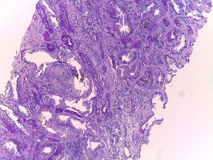 Periodic acid schiff stain (PAS) – 10×. Highlights acute tubular necrosis and areas of tubular atrophy.