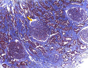 Masson trichrome stain – 10×. Highlights glomerular segmental sclerosis (yellow arrow) and areas of interstitial fibrosis.