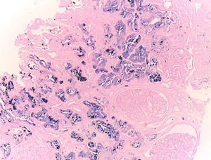 Iron stain – 10×. It highlights granular intraluminal and intracytoplasmic deposits of hemosiderin in the proximal tubules.